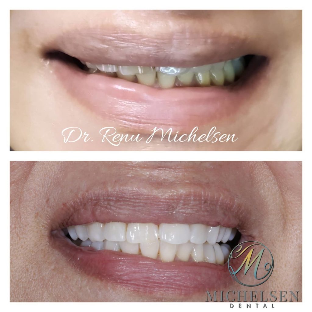 Professional teeth whitening treatment for brighter teeth
