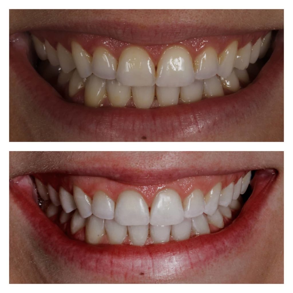 Teeth whitening procedure for a clean, radiant smile