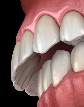 Illustration of overbite